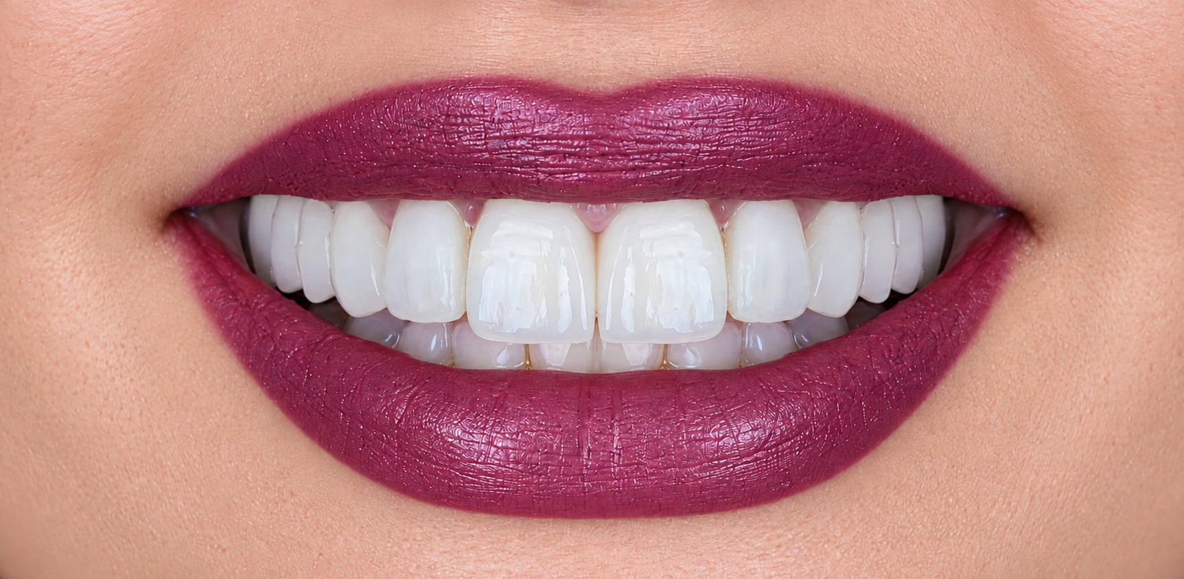 Client-supplied close-up image of a smile with cosmetic dental veneers.